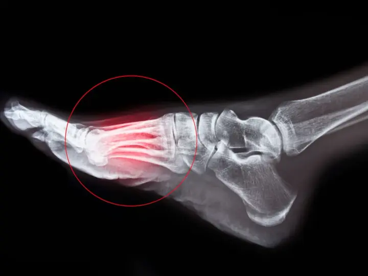 Radiographie du pied montrant une fracture de fatigue métatarsienne, avec une zone rouge indiquant la douleur. Le temps de guérison est essentiel.