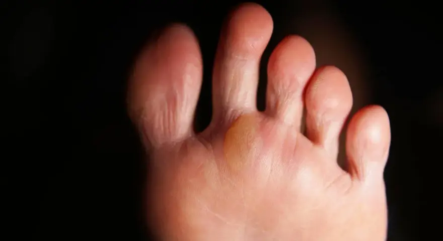 Gros plan sur un pied, montrant une phlyctène jaune entre deux orteils, signe d'une irritation due à la marche.