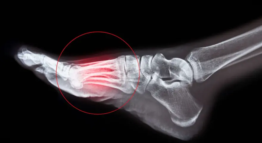 Radiographie du pied montrant une fracture de fatigue métatarsienne, avec une zone rouge indiquant la douleur. Le temps de guérison est essentiel.