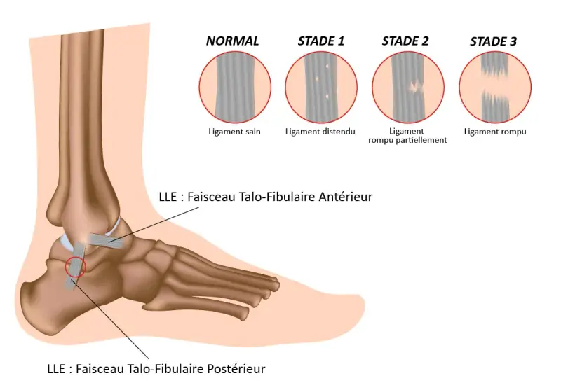 Illustration des différents stades d'une entorse du pied, du ligament sain au ligament rompu.